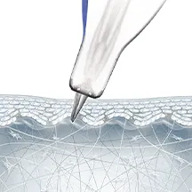 레이저가 피부 표면에 조사되는 모습을 나타낸 3D 그림