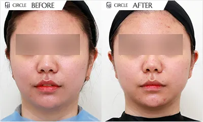 리프팅 시술 전후 비교 사진 (사례 6, 정면)