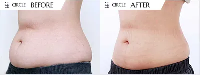 복부 라인 소멸핏 시술 전후 비교 사진 (사례 15, 3개월 경과)