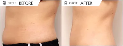복부 라인 소멸핏 시술 전후 비교 사진 (사례 3, 3개월 경과)