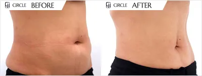 복부 라인 소멸핏 시술 전후 비교 사진 (사례 8, 1개월 경과)