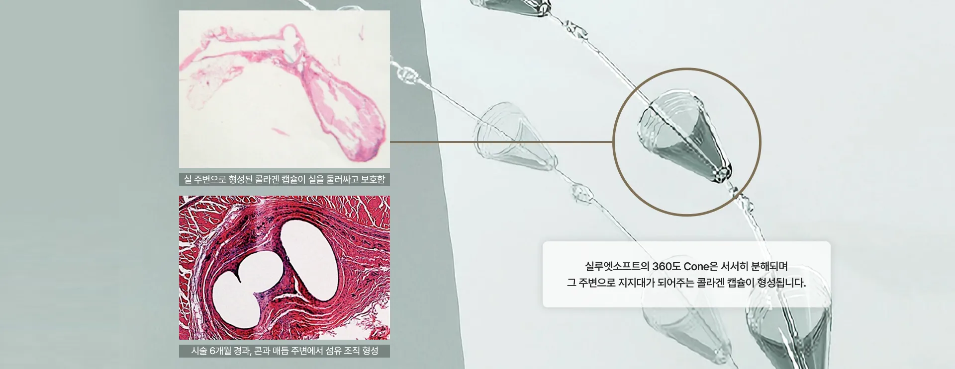 실루엣소프트 360S CONE 주변에 형성된 콜라겐 캡슐의 조직 검사 사진