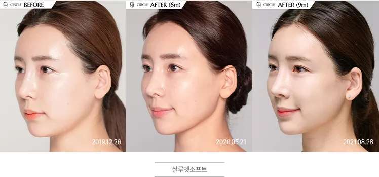 실루엣소프트 시술 전후 비교 사진 (사례 1 측면, 시술 전·6개월 후·9개월 후)