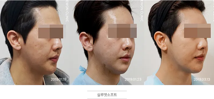 실루엣소프트 시술 전후 비교 사진 (사례 3, 시술 전·시술 후·3개월 후)