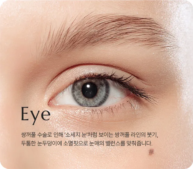 아이 소멸핏 안내 — 두툼한 눈두덩이를 정리해 눈매 밸런스를 맞추는 시술