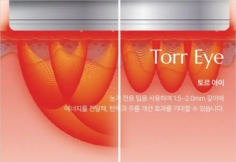 토르 아이(Torr Eye) 안내 — 눈가 전용 팁으로 1.5~2.0mm 깊이에 에너지를 전달하는 시술
