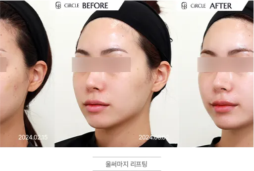울써마지 리프팅 시술 전후 비교 사진 (사례 1, 좌측·정면·우측)