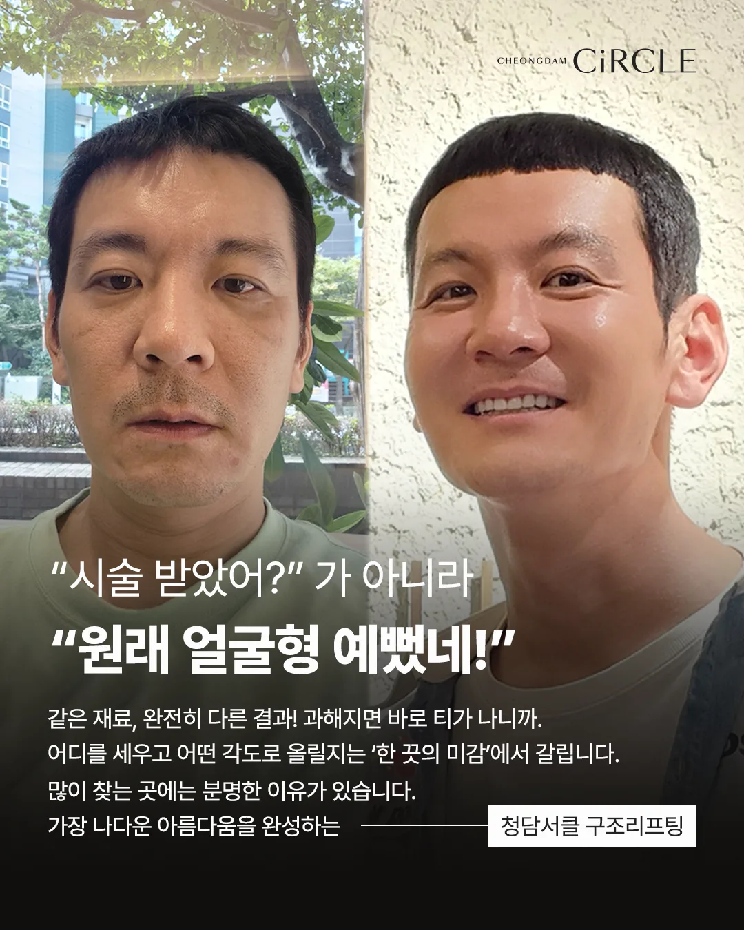 [의학 칼럼] 리프팅을 해도 아쉬운 이유? 얼굴의 구조를 고려한 ‘구조리프팅’ (10/10)