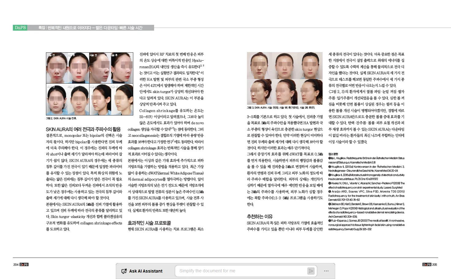 D&PS | 스킨아우라 RF 시술 (2/2)
