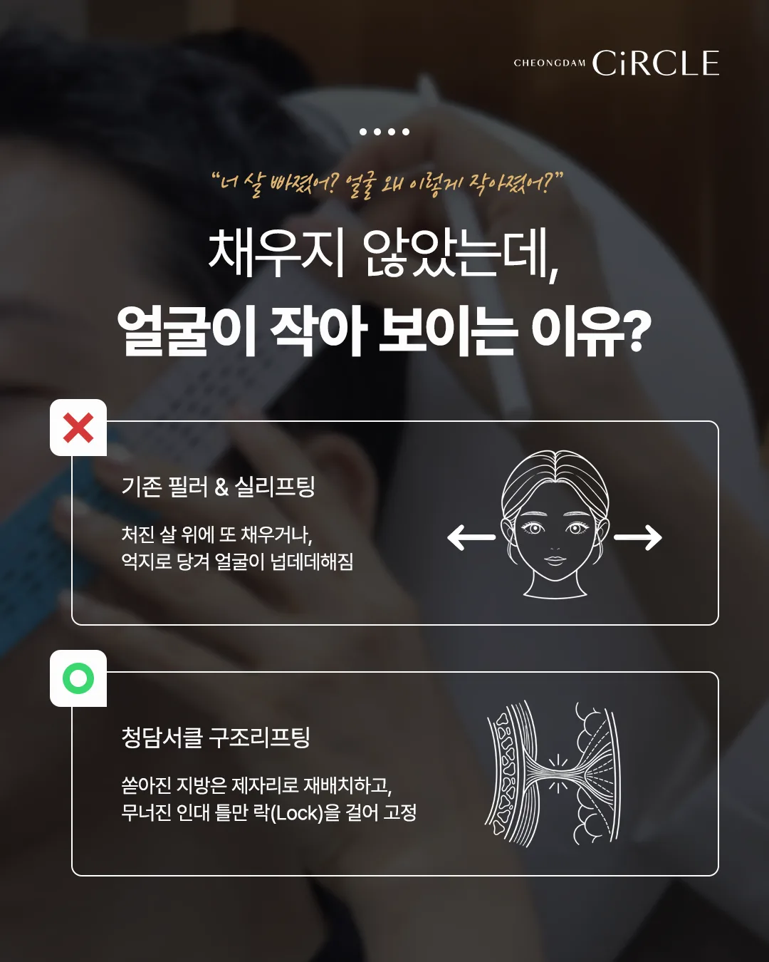[의학 칼럼] 리프팅을 해도 아쉬운 이유? 얼굴의 구조를 고려한 ‘구조리프팅’ (9/10)